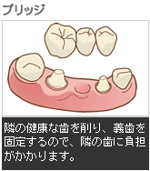 隣の健康な歯を削り、義歯を固定するので、隣の歯に負担がかかります。