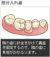 隣の歯に針金をかけて義歯を固定するので、隣の歯に負担がかかるリます。