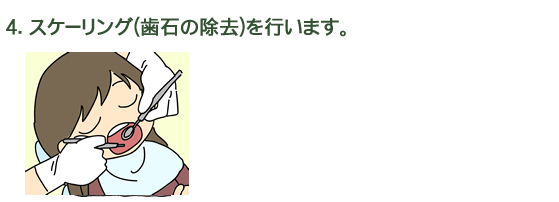 4.スケーリング(歯石の除去)を行います。