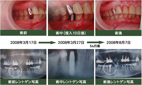 インプラント症例