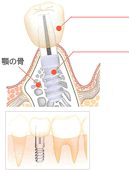 インプラントの構造図